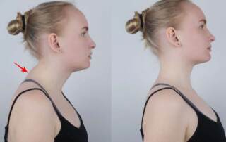 Dowagers hump brighton chiropractor 1 1536x864 1